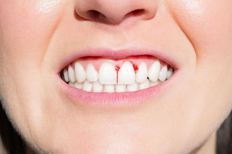 Điều trị viêm lợi