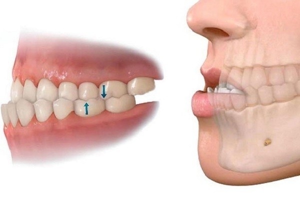 Niềng Răng Móm