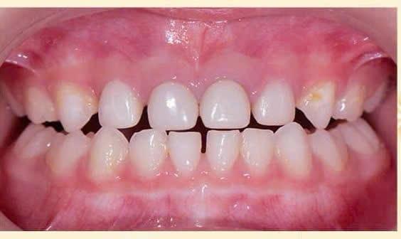 Chụp Zirconia tiền chế cho răng cửa