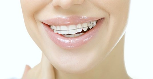 Đeo Hàm Duy Trì Sau Niềng Răng