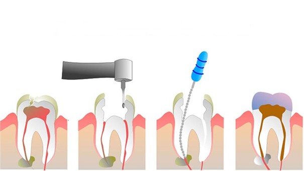 Điều trị tủy răng