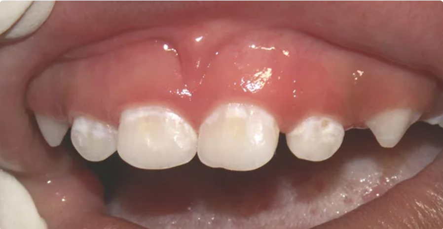 Đốm trắng trên răng sữa