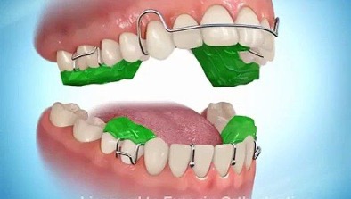 Khí cụ chỉnh nha tháo lắp