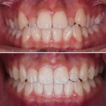 Niềng răng khấp khểnh