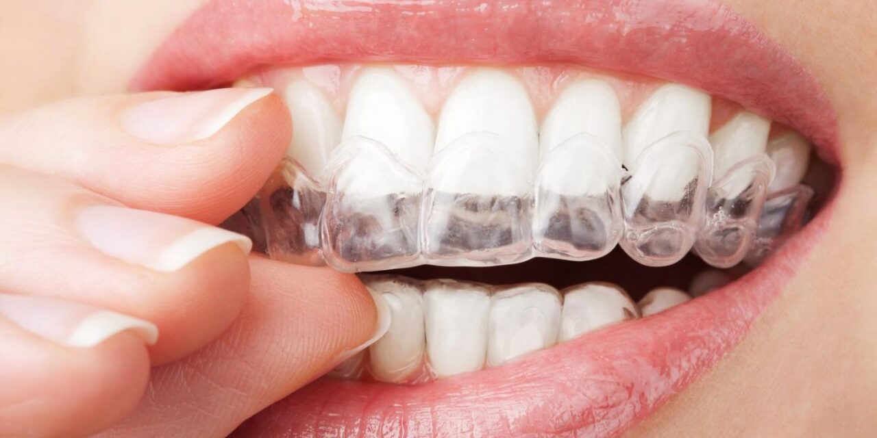 Niềng Răng Invisalign