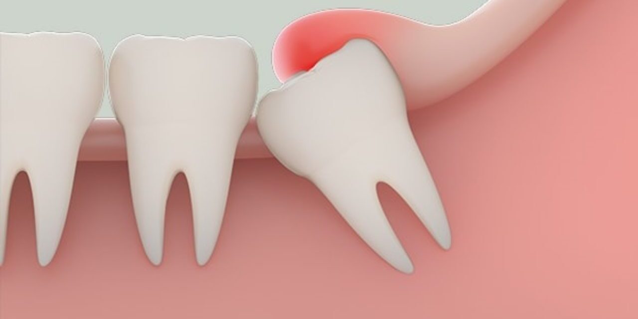 Răng khôn – trường hợp cần nhổ răng khôn