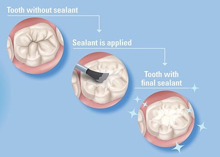 Trám bít hố rãnh