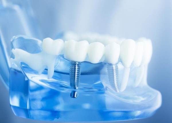 Cấy ghép Implant có đau không