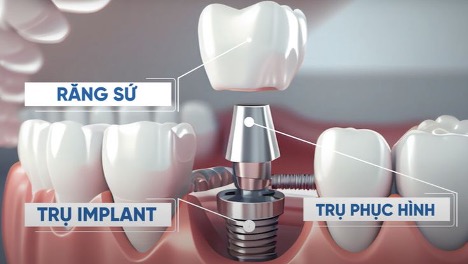 Quy trình cấy ghép implant tại Infi Dental