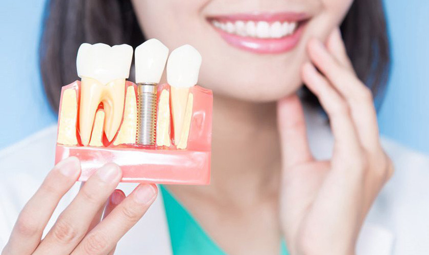 So sánh Implant và các phương pháp phục hồi răng khác